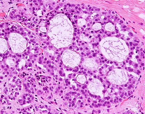 Lobular carcinoma in situ / Atypical Lobular Hyperplasia — EZ-Path