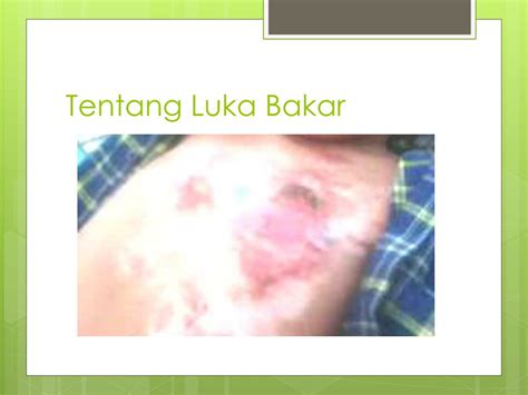 Ppt Pertolongan Pertama Pada Luka Bakar Powerpoint Presentation Free