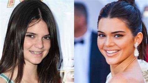 Celebrities Invisalign