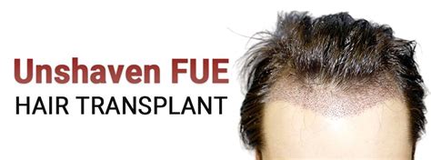 Unshaven Fue Hair Transplant And Cost In Delhi India