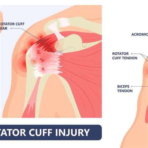 Shoulder Dr Eric Giang