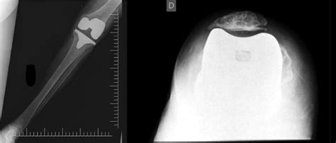 Scielo Brasil Total Knee Arthroplasty In Patients With Permanent