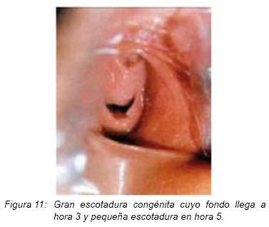Desgarro Y Escotadura Cong Nita Del Himen Su Valoraci N Medicolegal