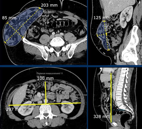 The Radiology Assistant Abdominal Wall Hernias