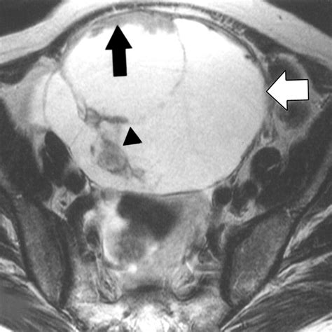 Characterization Of Adnexal Mass Lesions On Mr Imaging Ajr