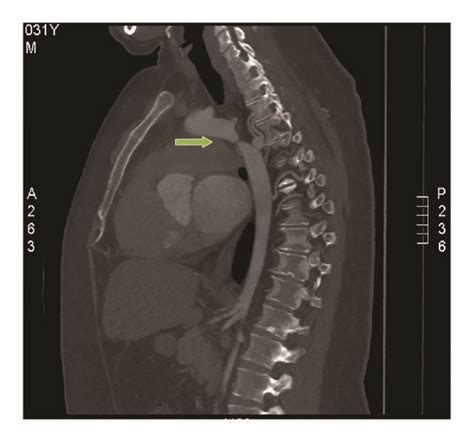 Ct Of Left Upper Limb Showing Coarctation Of The Aorta At The Isthmus Download Scientific Diagram