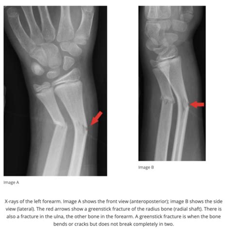 Peds Exam Musculoskeletal Flashcards Quizlet