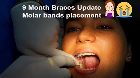 Braces Journey India Molar Bands Placement Molars Th Month Braces