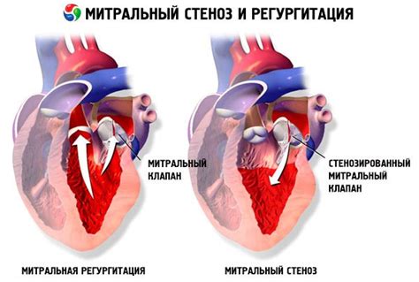 Estenosis Mitral Causas Síntomas Diagnóstico Tratamiento