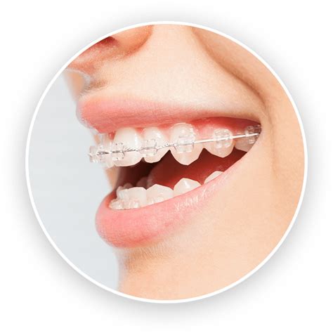 Clear Esthetic Braces, Ceramic Brackets, Coated Wires