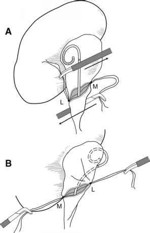 Performing The Anastomosis Radical Nephrectomy