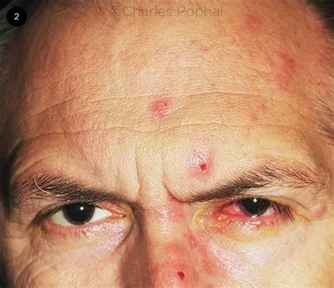 Herpes Zoster Ophthalmicus American Academy Of Ophthalmology