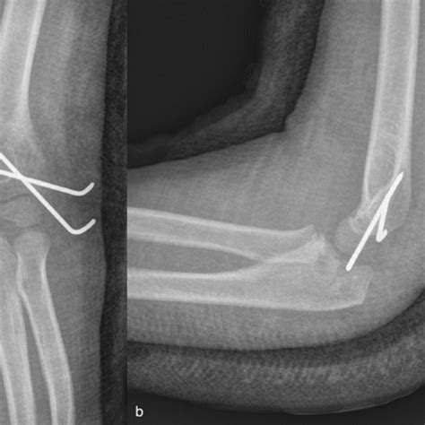 Radiographs At 1 Postoperative Year A Anteroposterior View B Lateral View Download