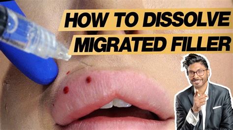 Lip Filler Dissolving Process For Migration In Real Time Youtube