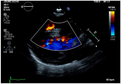 Unusual Longevity Of Edwards Syndrome A Case Report