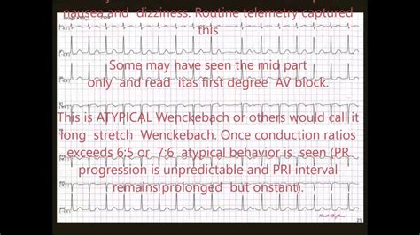 Atypical Wenckebach Youtube