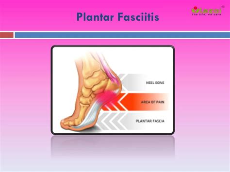 Ppt Plantar Fasciitis Causes Symptoms Daignosis Prevention And Treatment Powerpoint