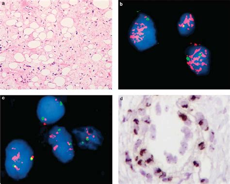 Well Differentiated Liposarcoma Atypical Lipomatous Tumor A