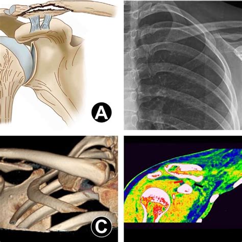 Zanca view radiograph for evaluation of the injury pattern of CC ...