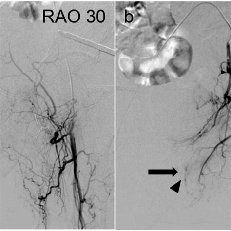 Pseudoaneurysms Shown By Angiography A Right Deep Femoral Artery Download Scientific Diagram