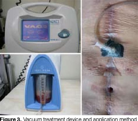 Pdf Use Of Vacuum Assisted Closure In The Topical Treatment Of