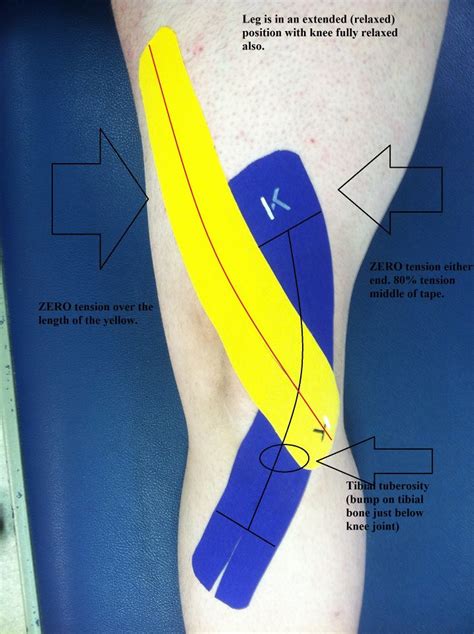 Kt Tape For Quad Pain Version 2 Chondromalacia Patella Or Medial Knee