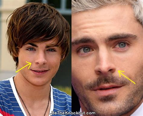 Zac Efron Plastic Surgery Comparison Photos