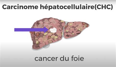 La Cirrhose Et Le Cancer Du Foie Canadian Liver Foundation