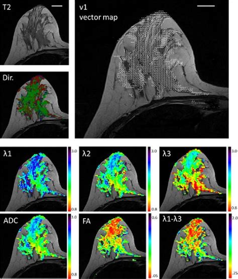 Should Gadolinium Based Contrast Agents Be Used In Breast Dti