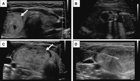 A Grayscale ultrasound. Transverse, thyroid midline. 16 weeks pregnant ...