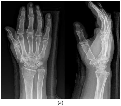 Comparative Evaluation Of The Efficacy Of Combined Intramedullary