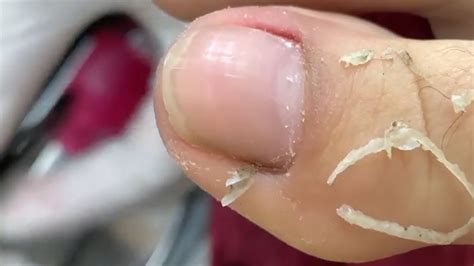 HOW TO CUT THICK TOENAILS Toenail Cleaning Satisfying 275 YouTube