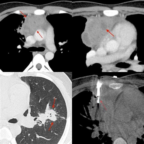 Prevascular Space Mediastinal Mass Tb The Great Mimic Ref India