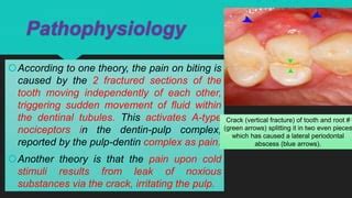 Cracked Tooth Syndrom Ppt