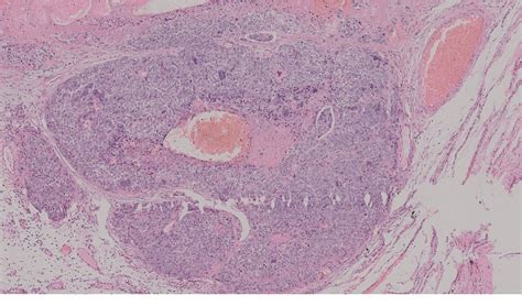 Figure 1 From Bilateral Wunderlich Syndrome Secondary To Synchronous Bilateral Testicular Germ