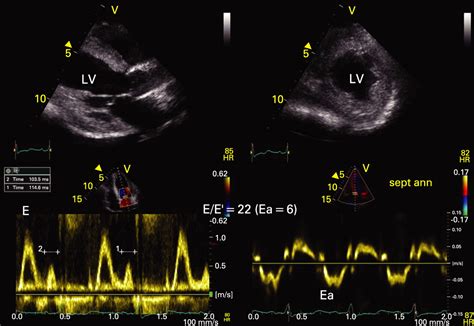 Echocardiography In The Emergency Room Heart