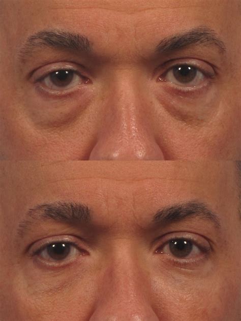 Eyelid Lift Blepharoplasty In Nyc Dr Brett Kotlus