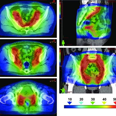 Dose Volume Histograms Of The PTV WP Phantom PTV CS Phantom Rectum