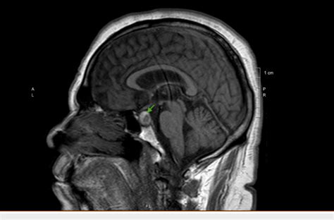 T1 Sagittal Section Of Magnetic Resonance Imaging Of The Brain Showing