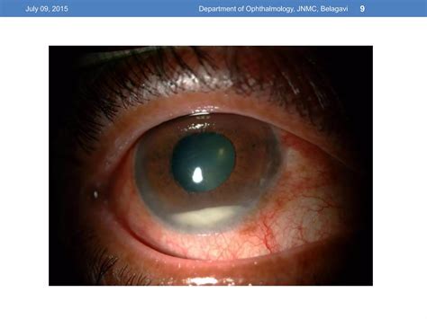 Infectious Uveitis Ppt