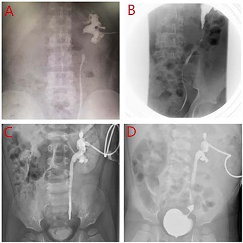 Laparoscopic Yang Monti Ureteral Reconstruction In Children Urology