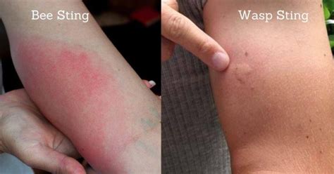 Bee Sting Vs Wasp Sting Which Is Dangerous Beesstyle