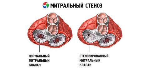 Estenose mitral causas sintomas diagnóstico tratamento