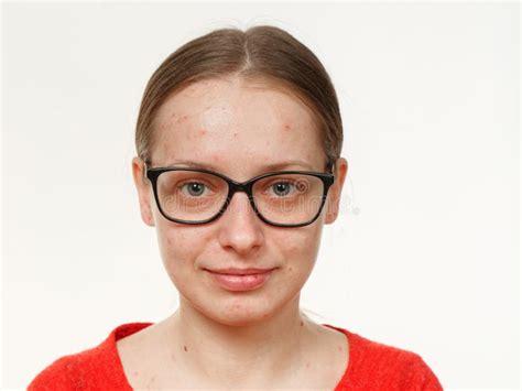 Portrait Of A Girl Without Makeup Acne On The Face Stock Photo Image
