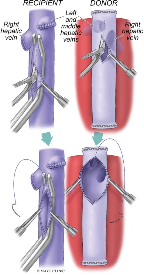 Interventional Radiology Management Of Adult Liver Transplant