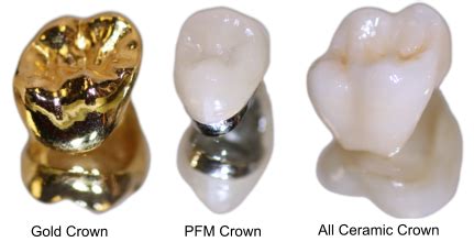 Dental Crown White Crowns Same Day Crowns Fix Broken Chipped Teeth. All Porcelain Crowns — S3 ...