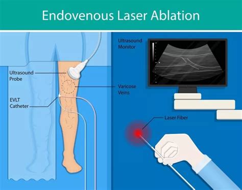 Endovenous Laser Radiofrequency Ablation For Varicose Vein