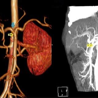 Abdominal computed tomography angiography shows that the celiac trunk ...