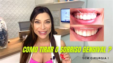 Sorriso Gengival Corre O Sem Cirurgia Poss Vel Descubra A Solu O