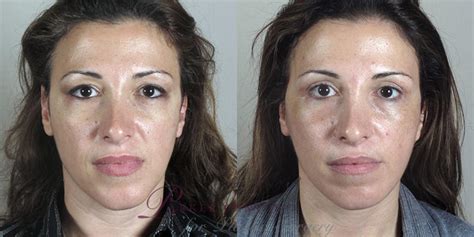 Facelift Before And After Pictures Case 28 Paramus New Jersey Parker Center For Plastic Surgery